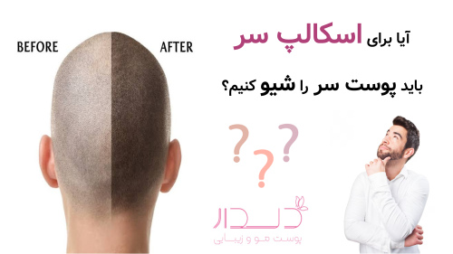 آیا برای اسکالپ سر باید پوست سر را شیو کنیم؟