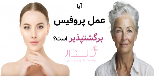 آیا عمل پروفیس برگشتپذیر است؟