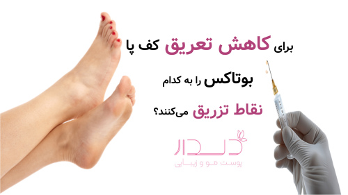 برای کاهش تعریق کف پا بوتاکس را به کدام نقاط تزریق می‌کنند؟