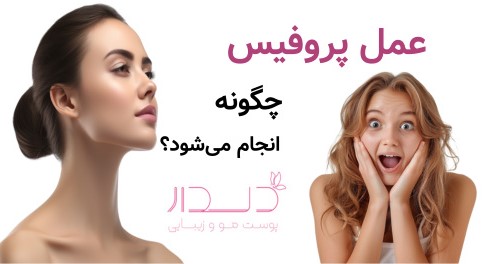 عمل پروفیس چگونه انجام می‌شود؟