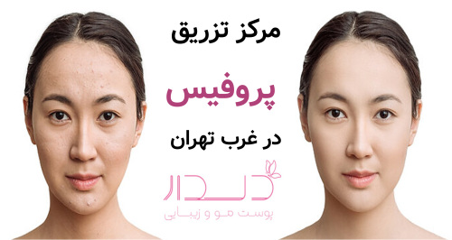 مرکز تزریق پروفیس در غرب تهران