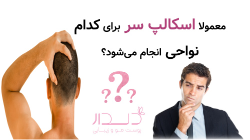 معمولا اسکالپ سر برای کدام نواحی انجام می‌شود؟