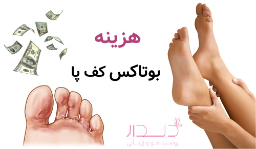 هزینه بوتاکس کف پا چقدر است؟