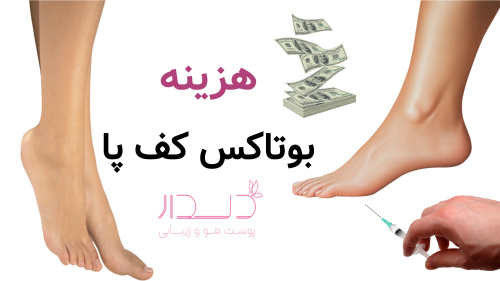 هزینه بوتاکس کف پا