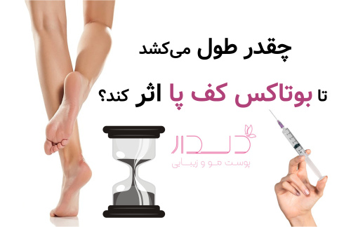 چقدر طول می‌کشد تا بوتاکس کف پا اثر کند؟