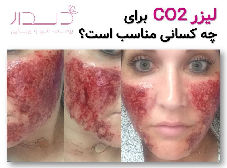 لیزر CO2 برای چه کسانی مناسب است؟