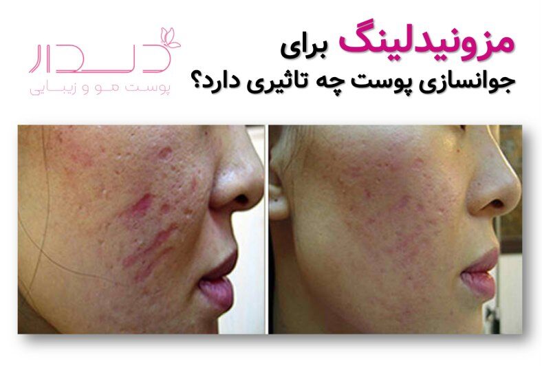 مزونیدلینگ برای جوانسازی پوست چه تاثیری دارد؟
