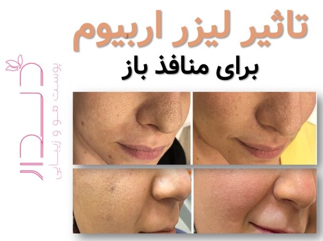 تاثیر لیزر اربیوم برای منافذ باز