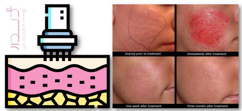 مزونیدلینگ برای جوانسازی پوست چه تاثیری دارد؟