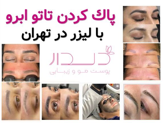پاک کردن تاتو ابرو با لیزر در تهران
