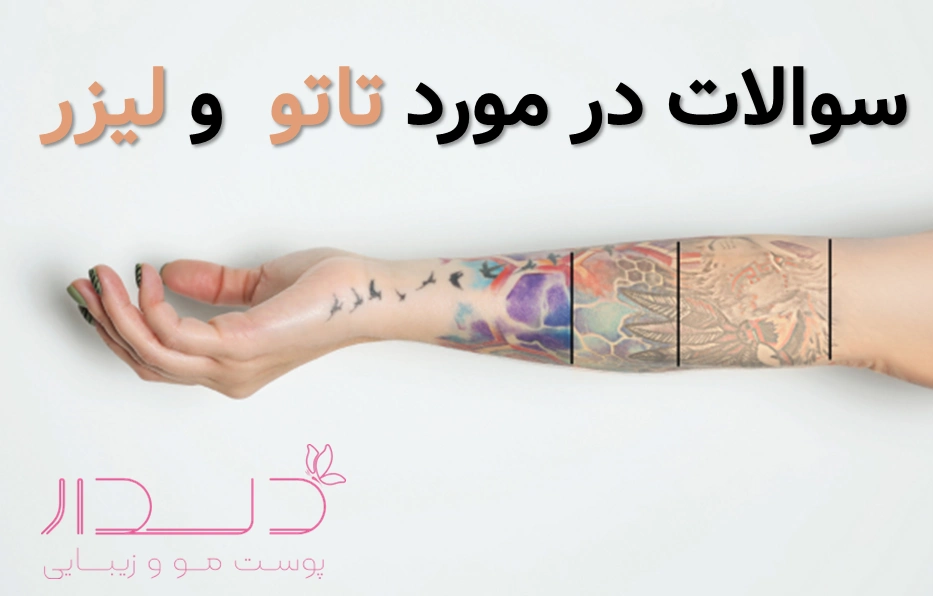 هزينه پاك كردن تاتو با ليزر (انواع دستگاه های لیزر)