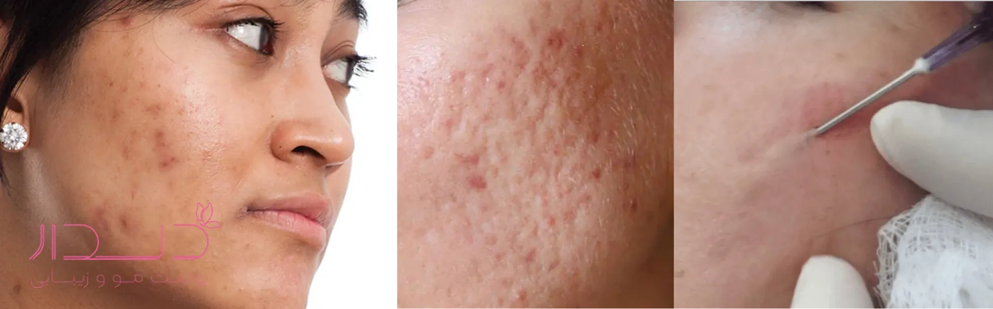 برای گودی پوست صورت چه باید کرد؟/10 روش کاربردی