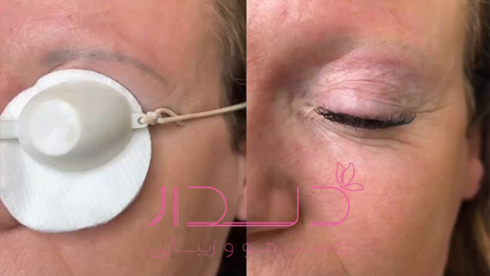 همه چیز در مورد پاک کردن تتو ابرو
