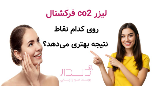 لیزر co2 فرکشنال روی کدام نقاط نتیجه بهتری می‌دهد؟