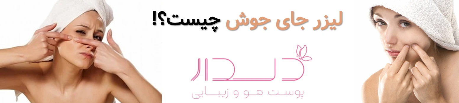 کدام لیزر برای جای جوش بهتر است؟/ تفاوت اربیوم، فرکشنال و IPL