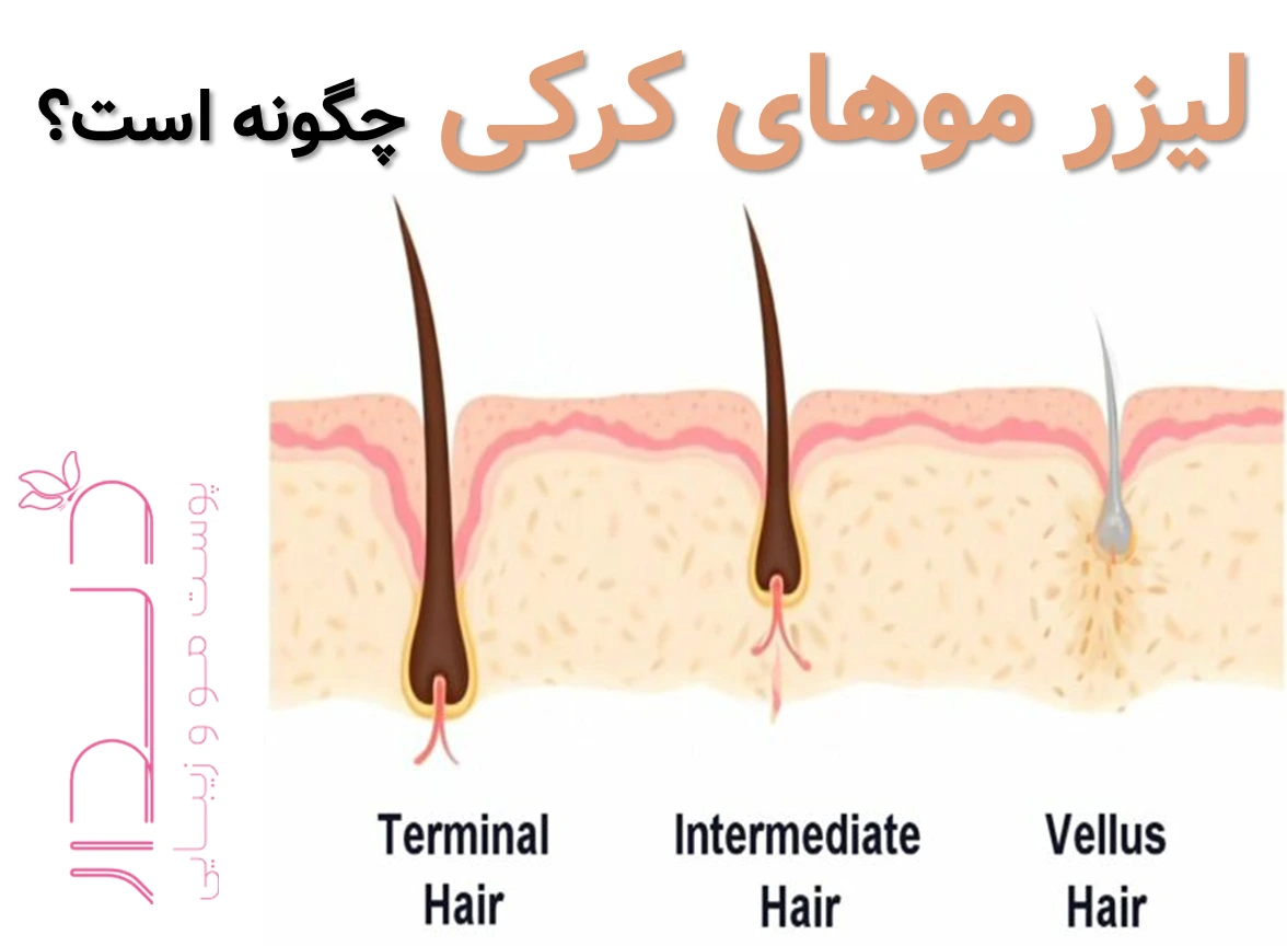 لیزر موهای کرکی چگونه است؟
