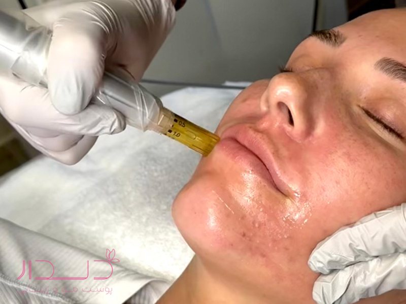 مزونیدلینگ برای جوانسازی پوست چه تاثیری دارد؟