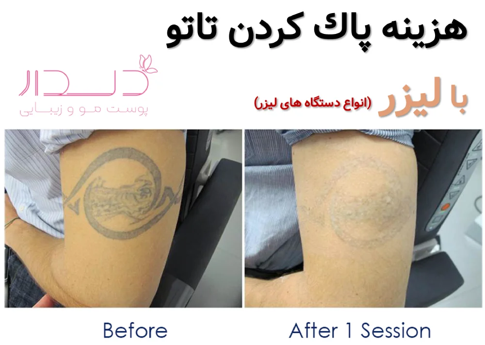 هزينه پاك كردن تاتو با ليزر (انواع دستگاه های لیزر)