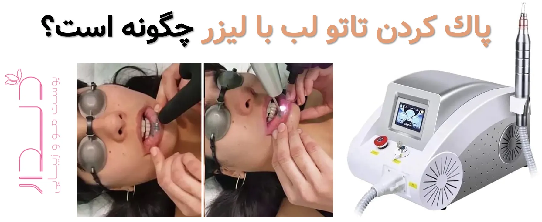 چگونه تاتو لب را پاک کنیم؟