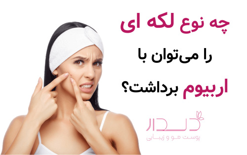 چه نوع لکه ای را می‌توان با اربیوم برداشت؟
