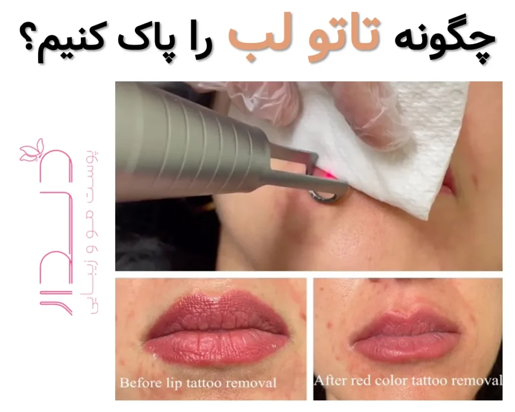 چگونه تاتو لب را پاک کنیم؟