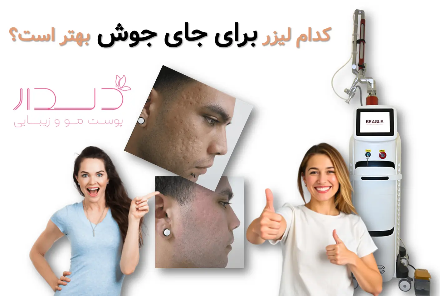 کدام لیزر برای جای جوش بهتر است؟/ تفاوت اربیوم، فرکشنال و IPL