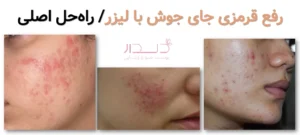 رفع قرمزی جای جوش با لیزر/ راهحل اصلی