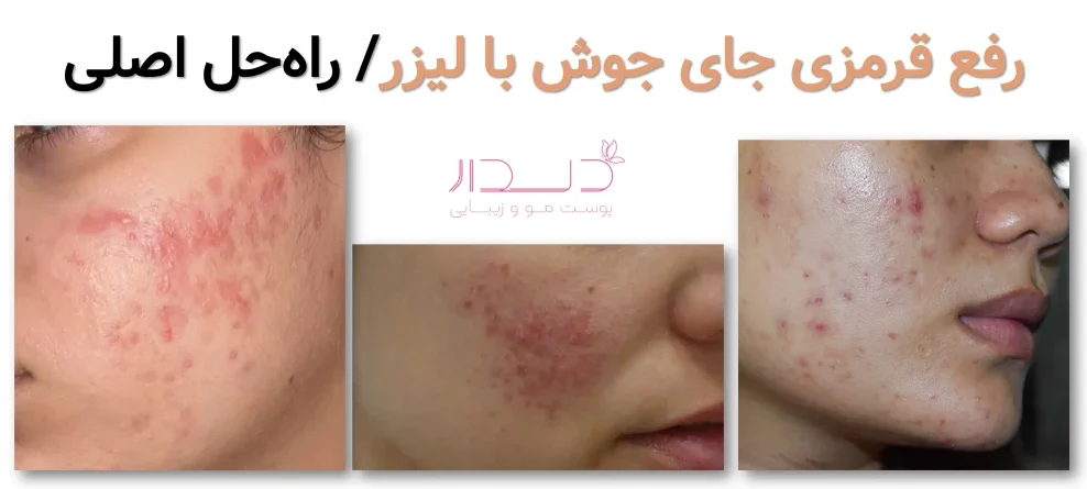 رفع قرمزی جای جوش با لیزر/ راه‌حل اصلی