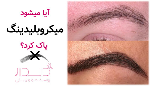 آیا میشود میکروبلیدینگ پاک کرد؟