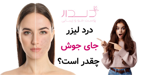 درد لیزر جای جوش چقد است؟