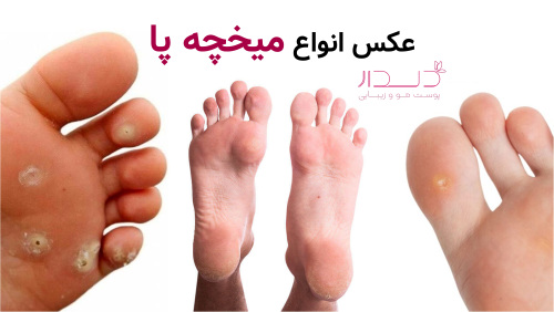 عکس انواع میخچه پا