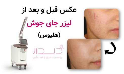 عکس قبل و بعد از لیزر جای جوش (هلیوس)