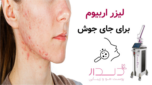 لیزر اربیوم برای جای جوش