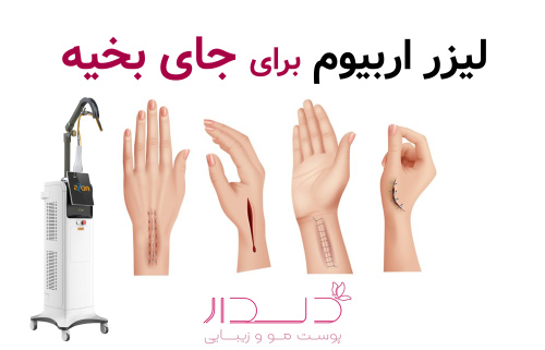 لیزر اربیوم جای بخیه