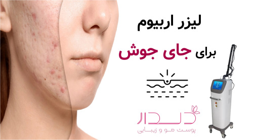 لیزر اربیوم جای جوش