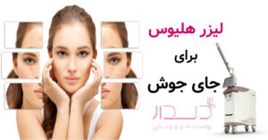 لیزر هلیوس برای جای جوش