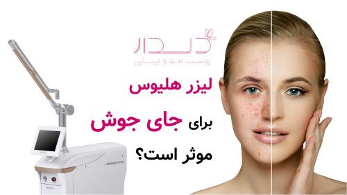 لیزر هلیوس برای جای جوش موثر است؟