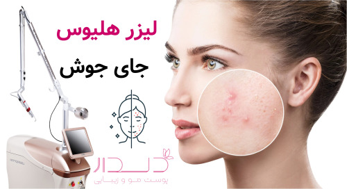 لیزر هلیوس جای جوش
