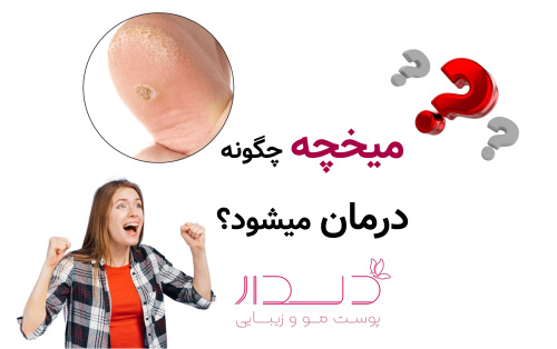 میخچه چگونه درمان میشود؟