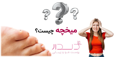 میخچه چیست؟