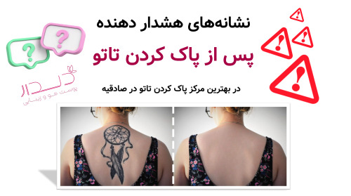 نشانه های هشدار دهنده پس از پاک کردن تاتو در بهترین مرکز پاک کردن تاتو در صادقیه