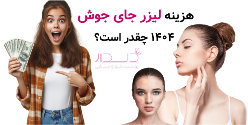 هزینه لیزر جای جوش ۱۴۰۴ چقدر است؟