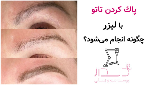 پاک کردن تاتو با لیزر چگونه انجام می شود؟