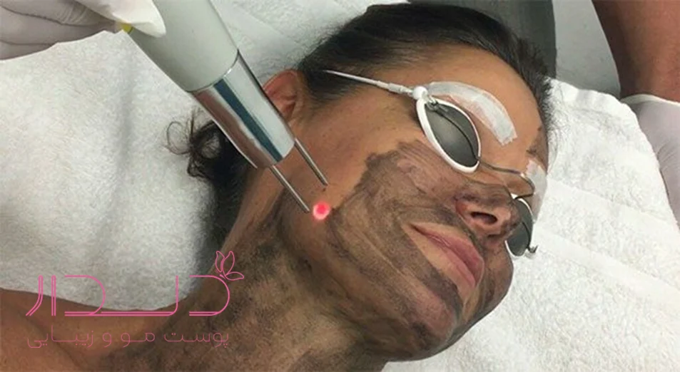 پیلینگ کربن صورت با لیزر کیوسوییچ