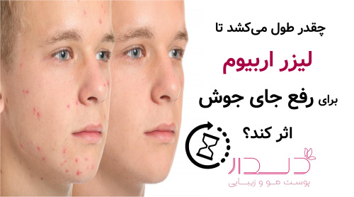 چقدر طول می‌کشد تا لیزر اربیوم برای رفع جای جوش اثر کند؟