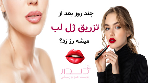 چند روز بعد از تزریق ژل لب میشه رژ زد