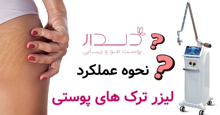نحوه عملکرد لیزر ترک های پوستی