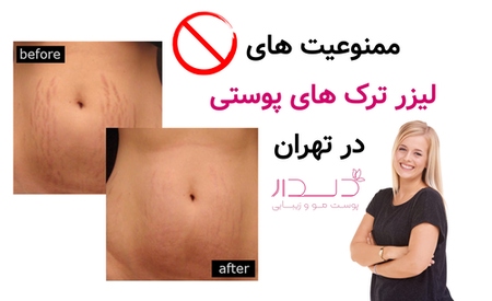 ممنوعیت های لیزر ترک های پوستی در تهران