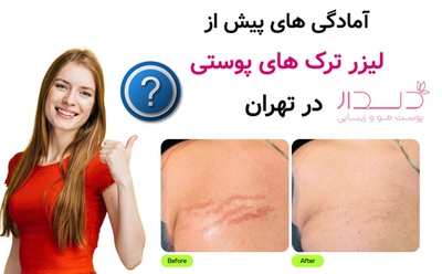 آمادگی های پیش از لیزر ترک های پوستی در تهران
