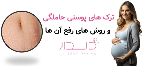 ترک های پوستی حاملگی و روش های رفع آن ها